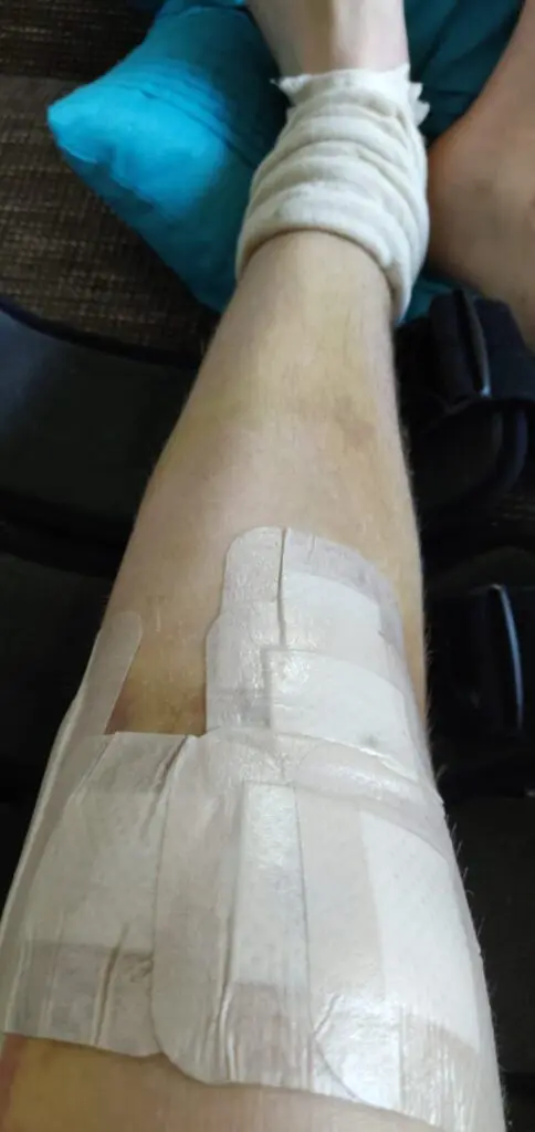 Knie na kruisbandoperatie met verband