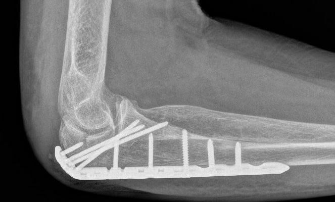 Fracturen en botgenezing